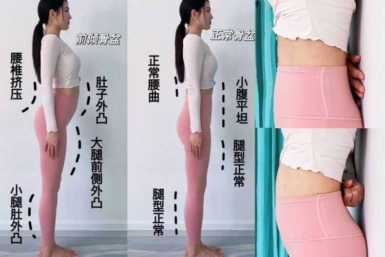 骨盆前傾的樣子與自我檢測方式