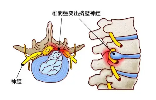 椎間盤突出擠壓神經